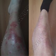 Эффективная помощь при псориазе, экземе, дерматите!